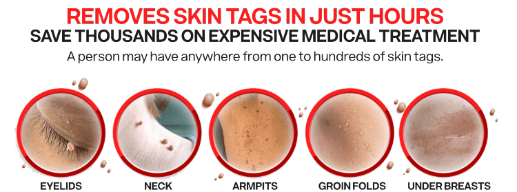 how to remove skin tags in one night
