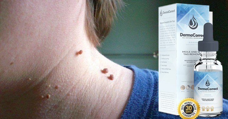 How I Remove My Skin Tags – Best Skin Tag Removal Secret for All Skin Tags, Mole and Wart