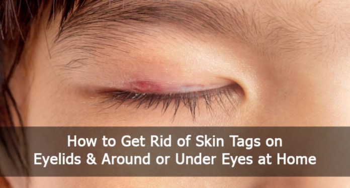 skin tags on eyelids betadine