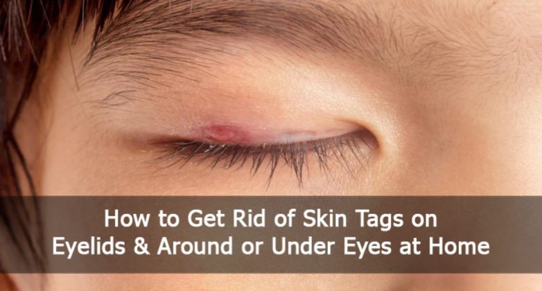 little skin tags on eyelids