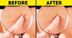 Removing Moles and Skin Tags