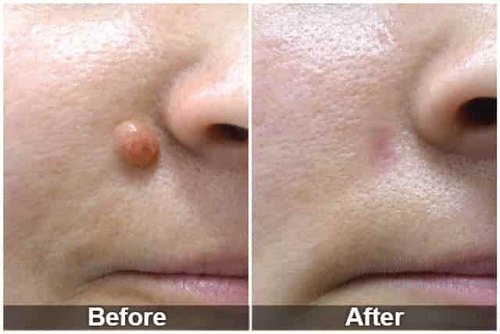 moles and skin tag removal treatment 500x500 1