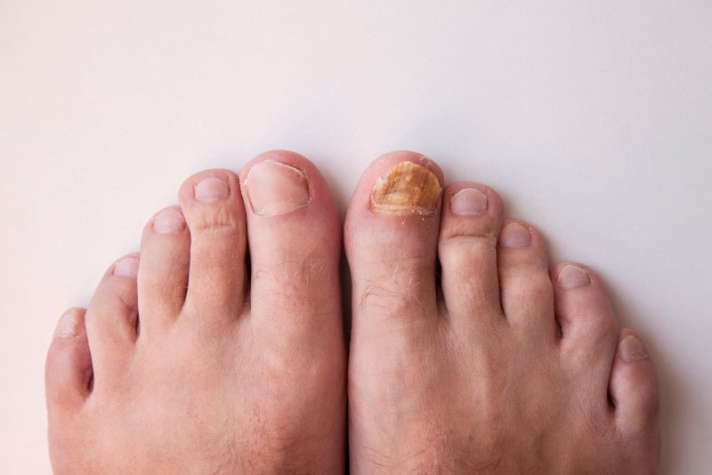 best cure for toenail fungus