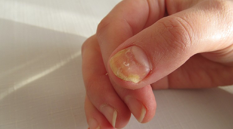 The Best Fungal Nail Treatment - 5 Top Rated cure for toenail fungus That Kills 99.9% Nail Fungus