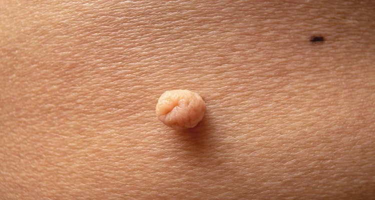 how to remove skin tags moles best skin tag removal