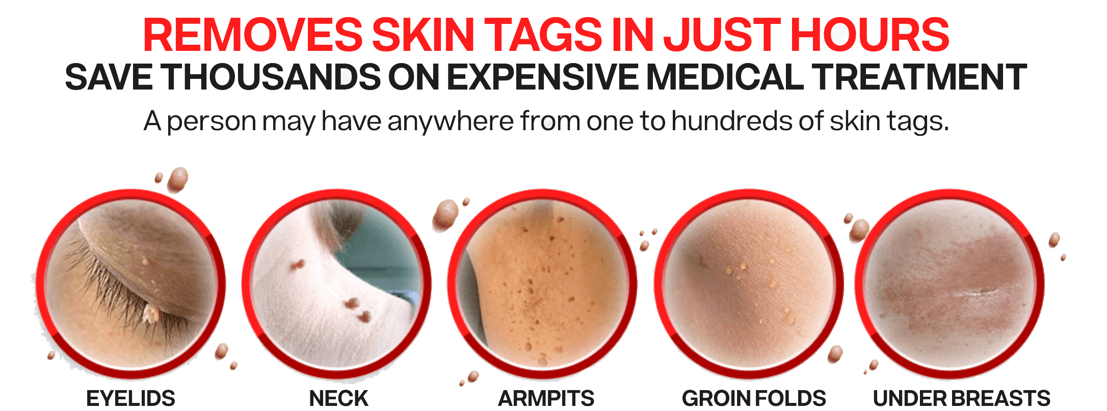 How to care for your skin after tag removal surgery