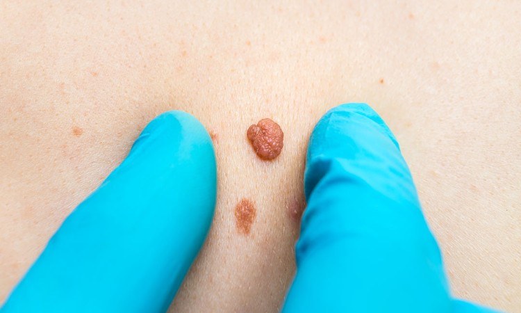 How to get rid of skin tags properly