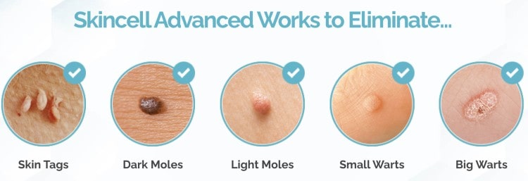The best way to remove skin tags - surgery, home remedies, or over-the-counter products
