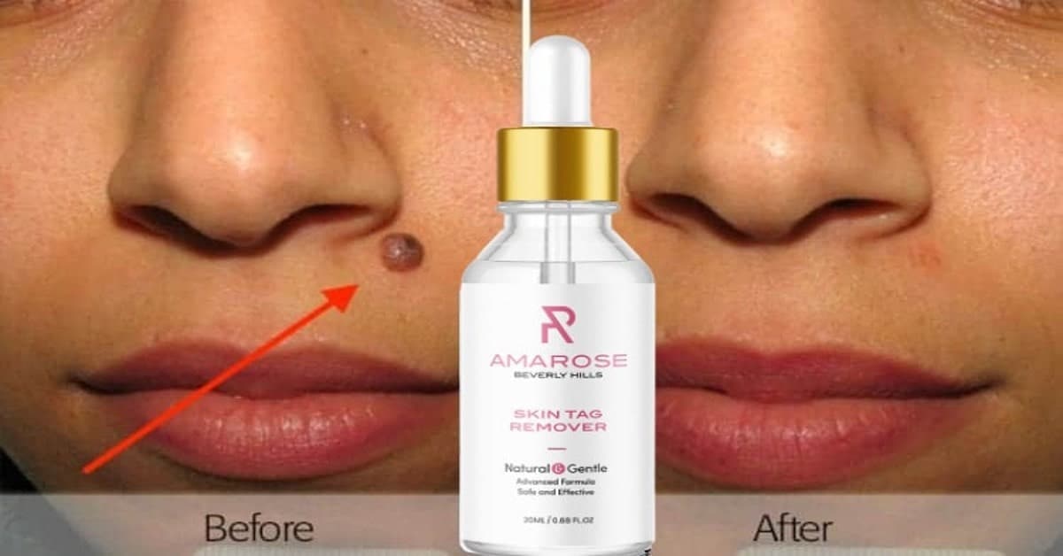 Amarose skin tag remover where to buy