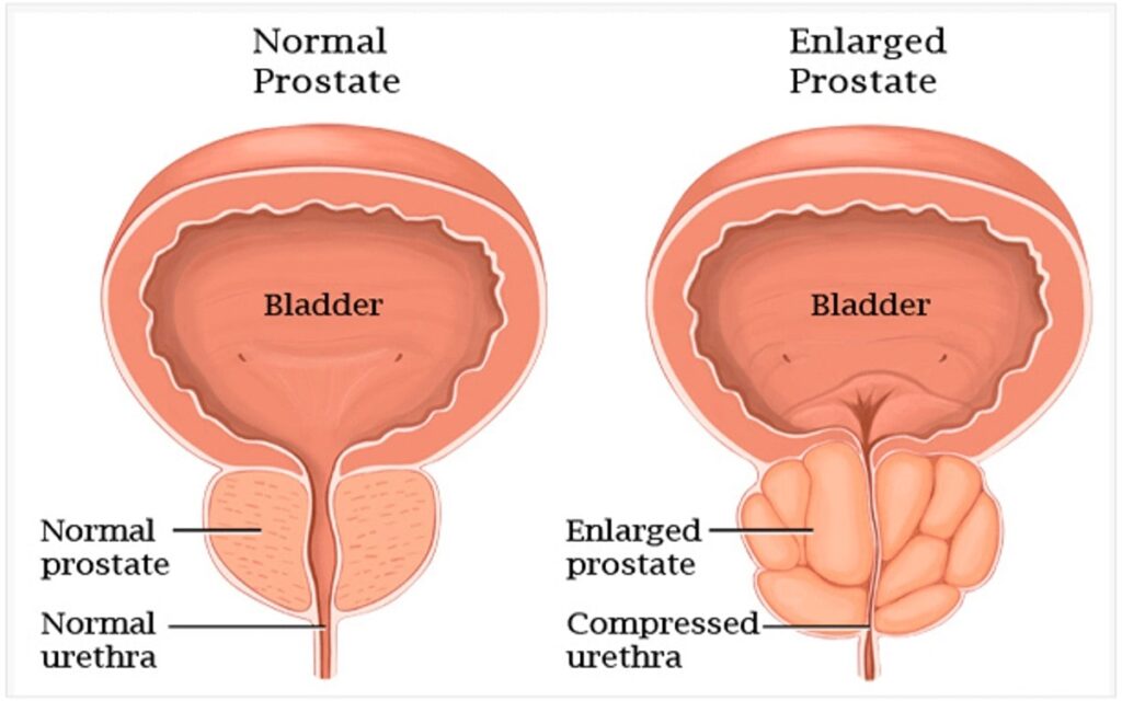 How to shrink enlarged prostate gland