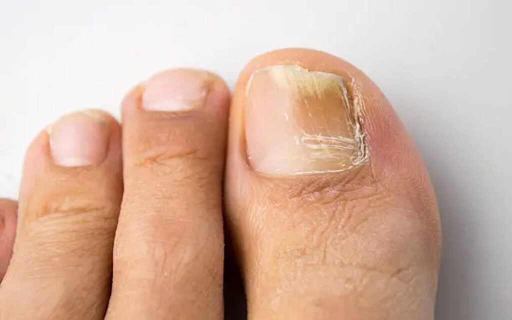 What Can I Use for Toenail Fungus? New Remedy for Toenail Fungus Keratone toenail oil review
