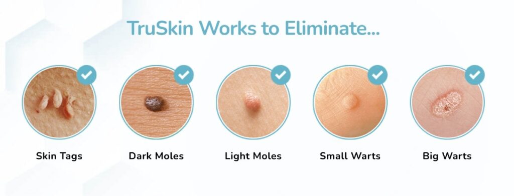 Tru Skin Fix Skin Tag Remover Reviews SECRET  Truskin Skin Tag Remover Serum 2023