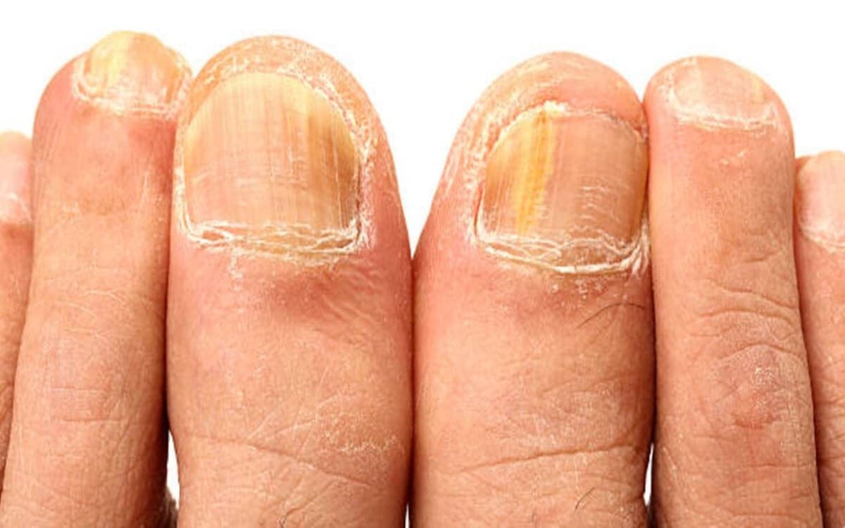 Can You Get Rid of Toenail Fungus? Yes! #1 Toenail Fungal Treatment That Works