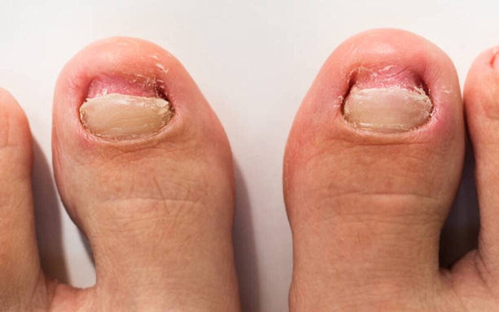 Fungal nail infection causes How To Prevent Fungal Nail Infections