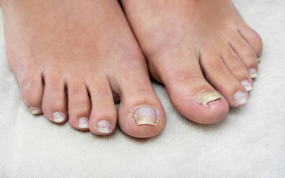 Best Supplements for Toenail Fungus Signs and Symptoms