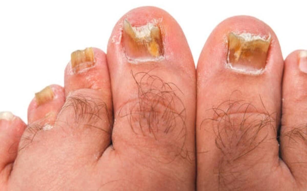 Why Do I Have Toenail Fungus? 5 Best Fungal Nail Infection Treatment